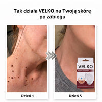 VELKO Plastry Na Brodawki
