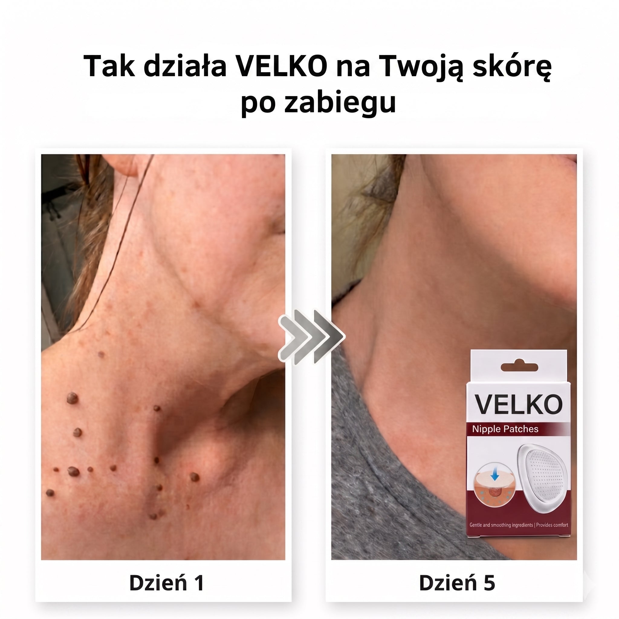 VELKO Plastry Na Brodawki