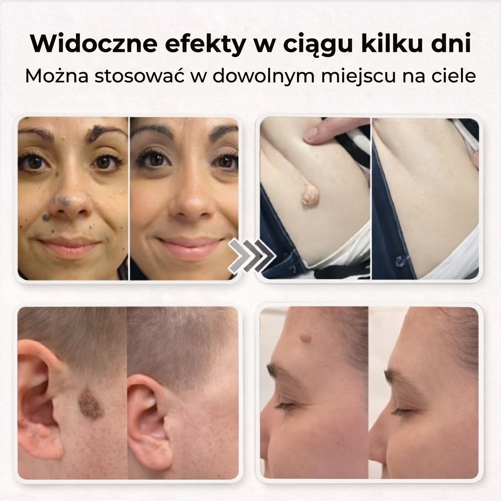 VELKO Plastry Na Brodawki
